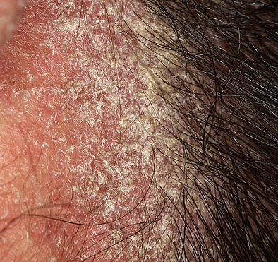 scabies on the scalp