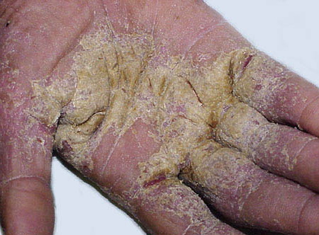 scabies in people