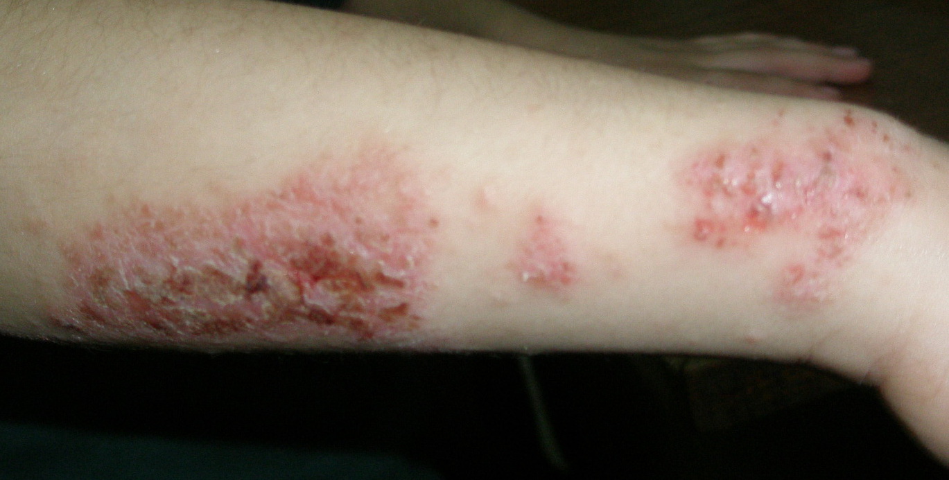 Pictures of Skin Diseases and Problems – Nummular Eczema