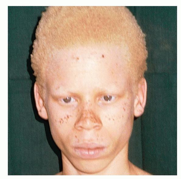 albinism in humans. Oculocutaneous albinism