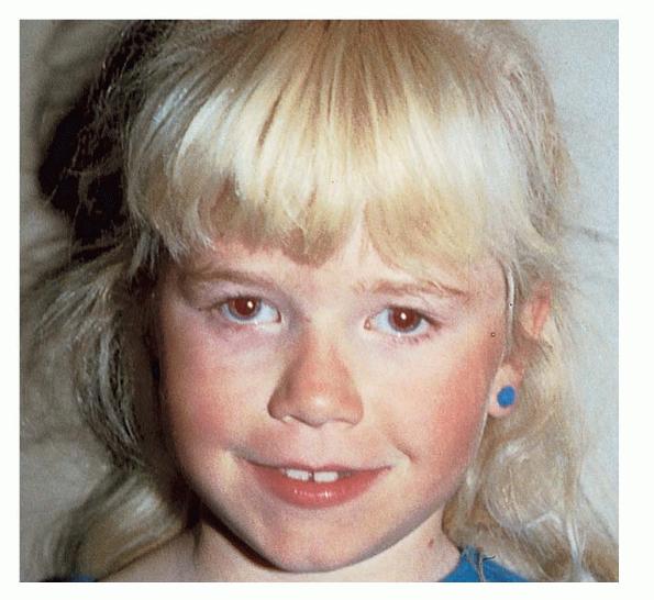 Кожно-глазные), изолированные (глазные) и смешанные типы альбинизма…