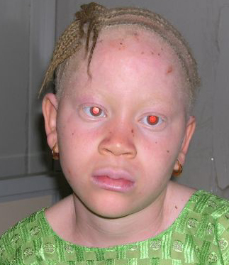 albinism in humans. Albinism -and Other