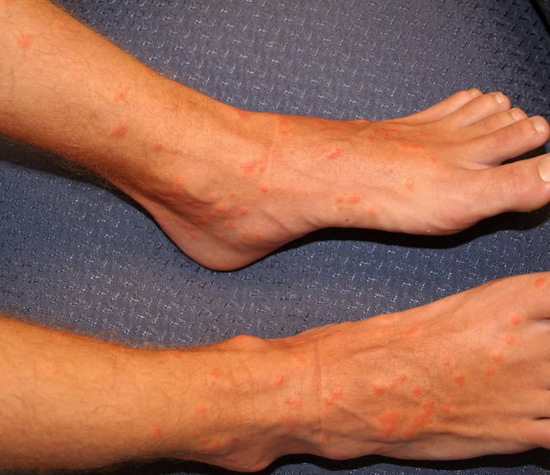 Contact Urticaria Syndrome Treatment & Management ...