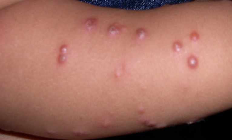 Papular urticaria | BabyCenter