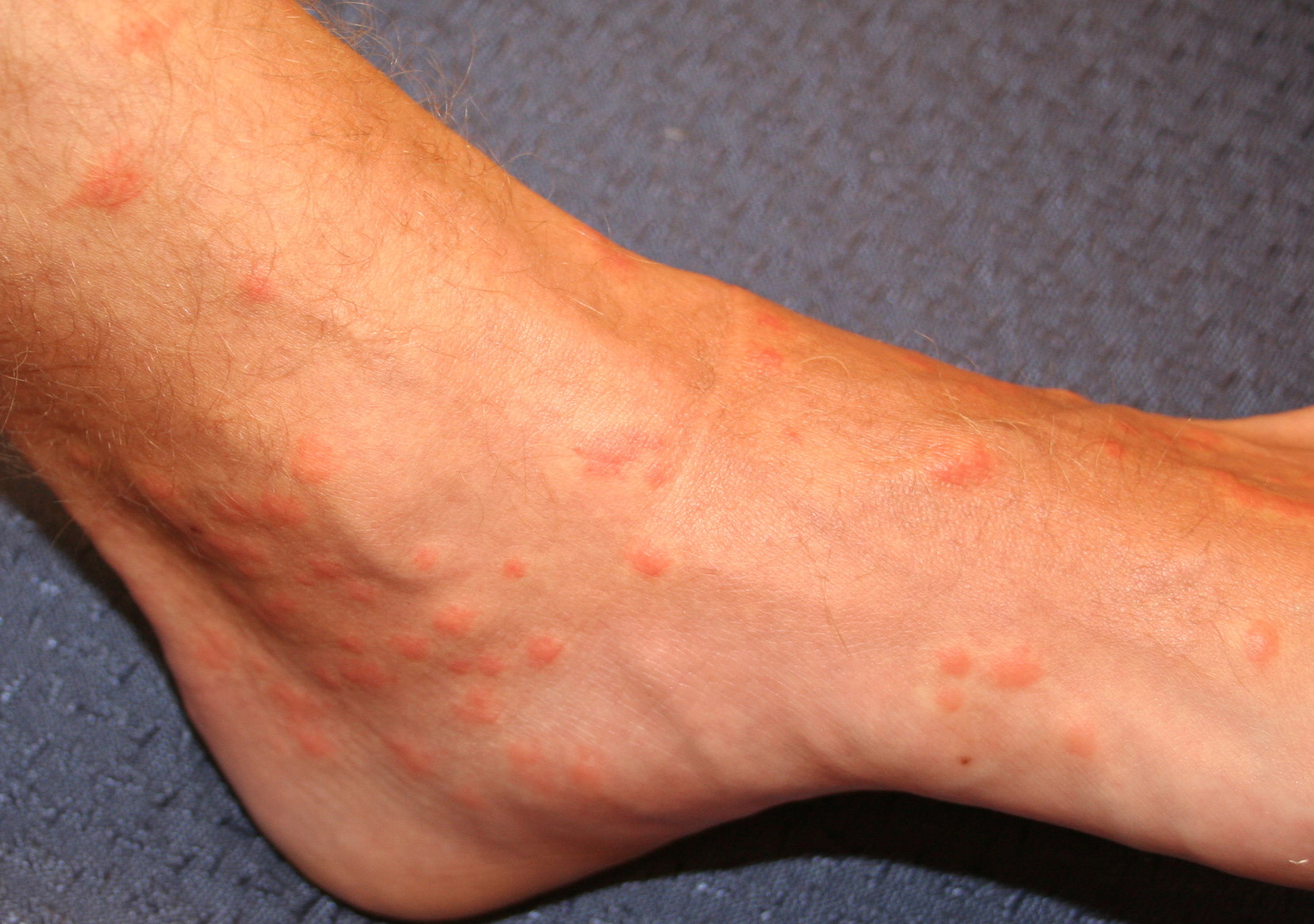 Urticaria Pictures | Pictures of Hives Rash | Hives Pictures | Hives rash Pictures