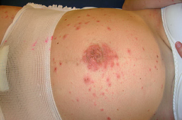 Dermatology Photo Gallery - Verywell