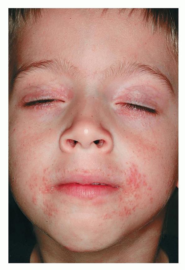 skinsight - Dermatitis, Perioral of Childhood