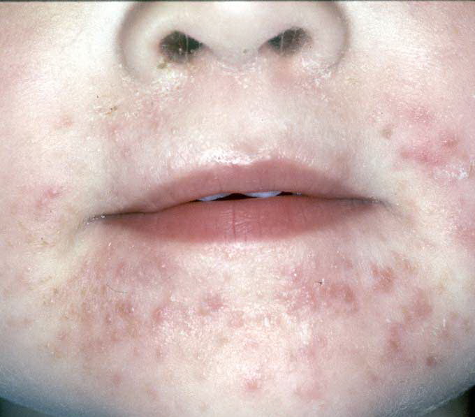 Perioral dermatitis: MedlinePlus Medical Encyclopedia