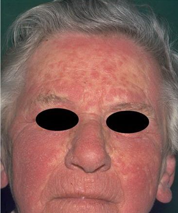 photoallergic dermatitis