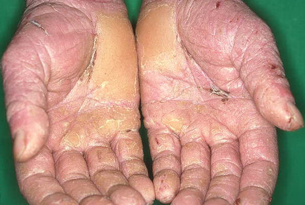 allergic contact dermatitis Picture Image on MedicineNet.com