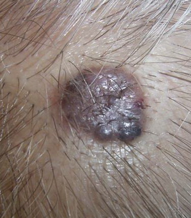 Basal Cell Carcinoma Pigmented Photos - Dermatology Education