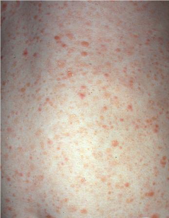 pityriasis lichenoides chronica #11