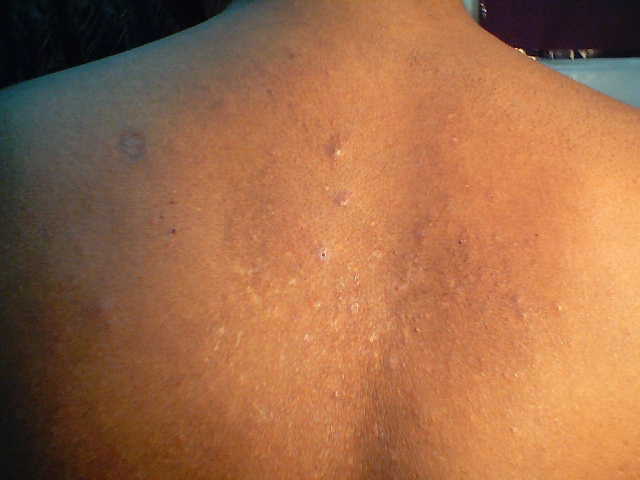 Folliculitis - Wikipedia