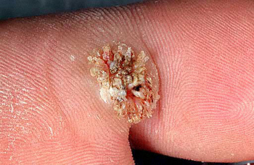 Plantar Wart Symptoms - WebMD