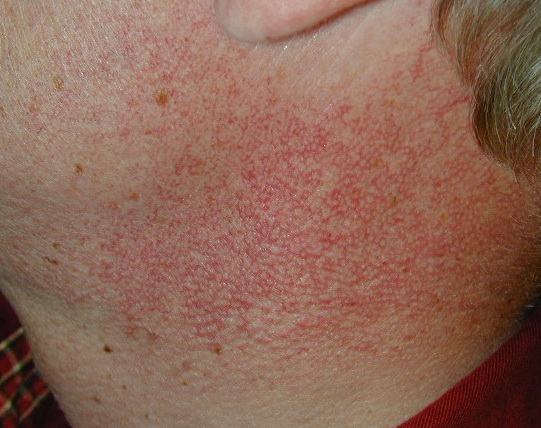 Poikiloderma van Civatte: rood-bruine huidverandering hals ...