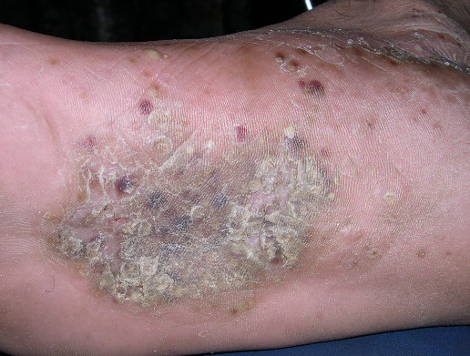 Acrovesiculeus eczeem (dyshidrotic eczema, eczema ...
