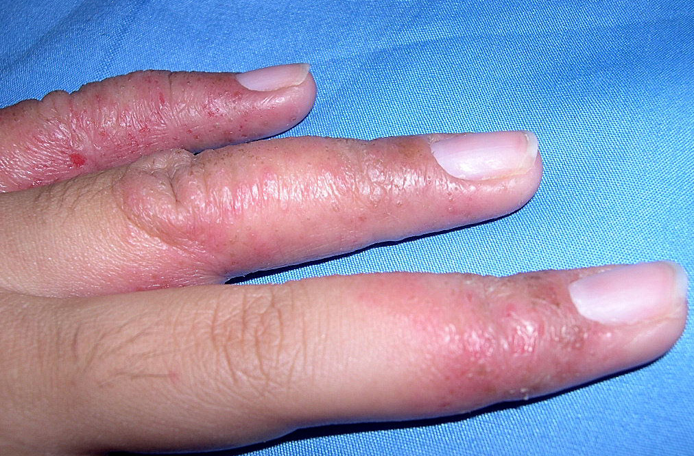Dyshidrotic Eczema: Overview, Causes, Diagnosis & Pictures