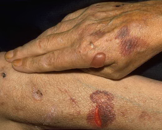 Porphyria cutanea tarda on the hands: MedlinePlus Medical ...