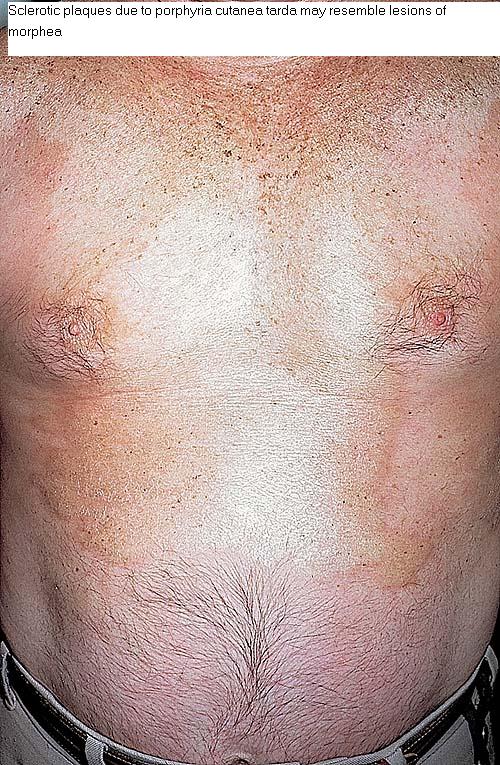 DermIS - Porphyria Cutanea Tarda (information on the ...