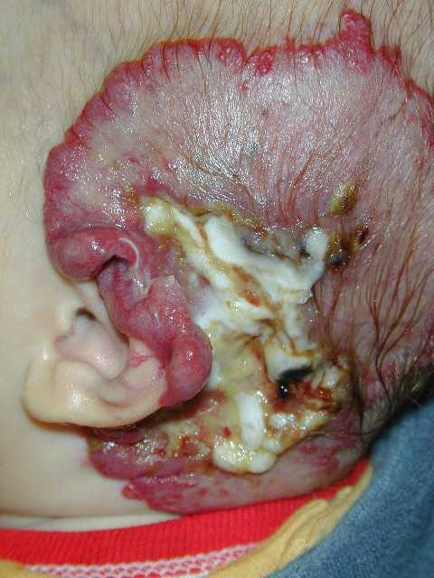 skin ulcers pictures