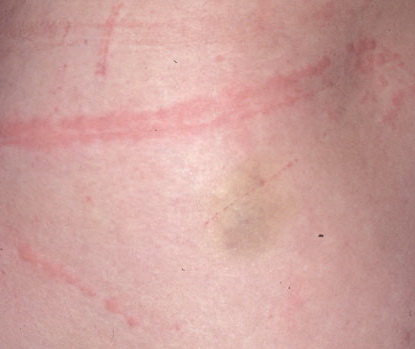 delayed pressure urticaria