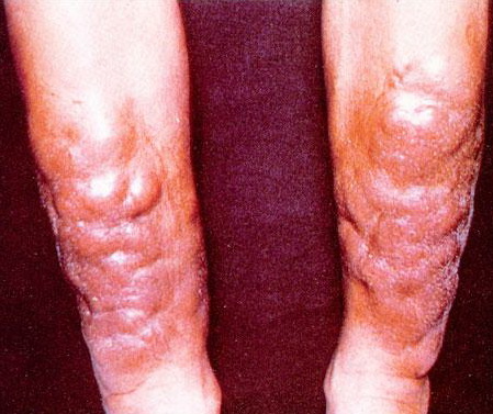 pretibial myxedema #11