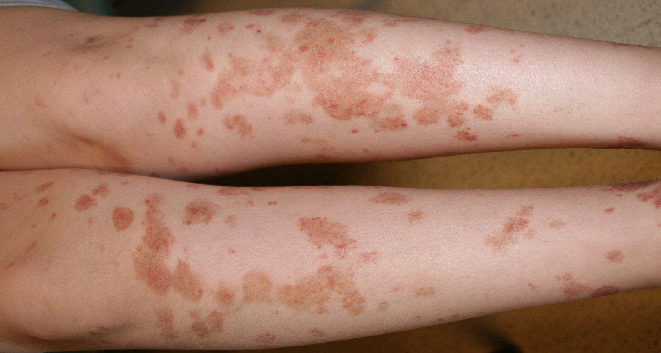 purpuric dermatosis