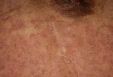 pruritic urticarial papules and plaques of pregnancy