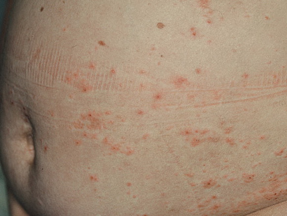 Urticarial Dermatitis Treatment - Dermatitis Information