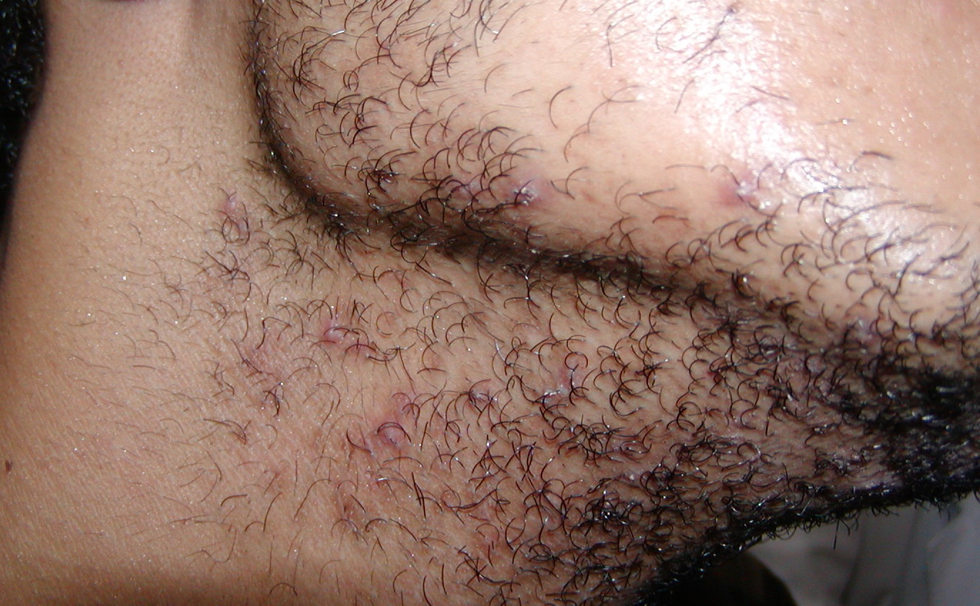 hair folliculitis treatment