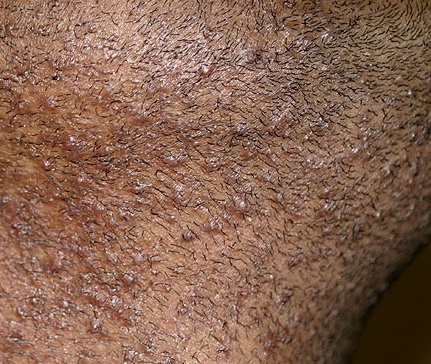 pseudofolliculitis barbae #11