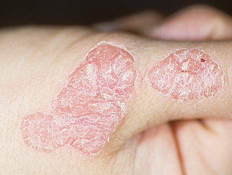 Psoriasis: Ik heb psoriasis | Thuisarts.nl