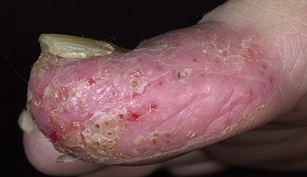 Psoriasis | Psoriatic Arthritis | MedlinePlus