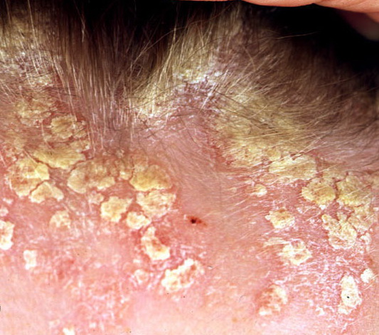 How do you treat scalp sores?