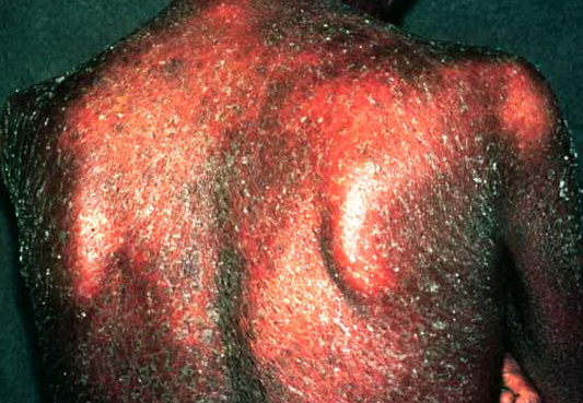 Psoriasis in Adults: Condition, Treatments, and Pictures ...