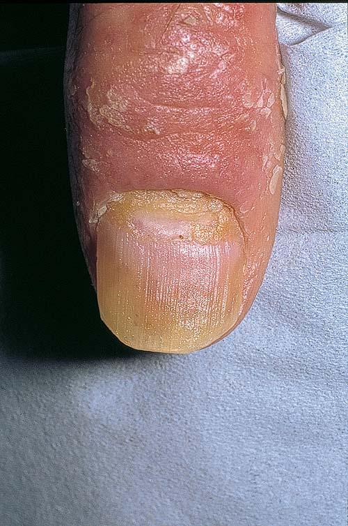 Nail Psoriasis: Pictures, Symptoms, and Treatments