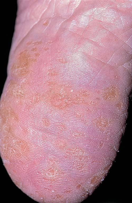 punctate keratoderma #11