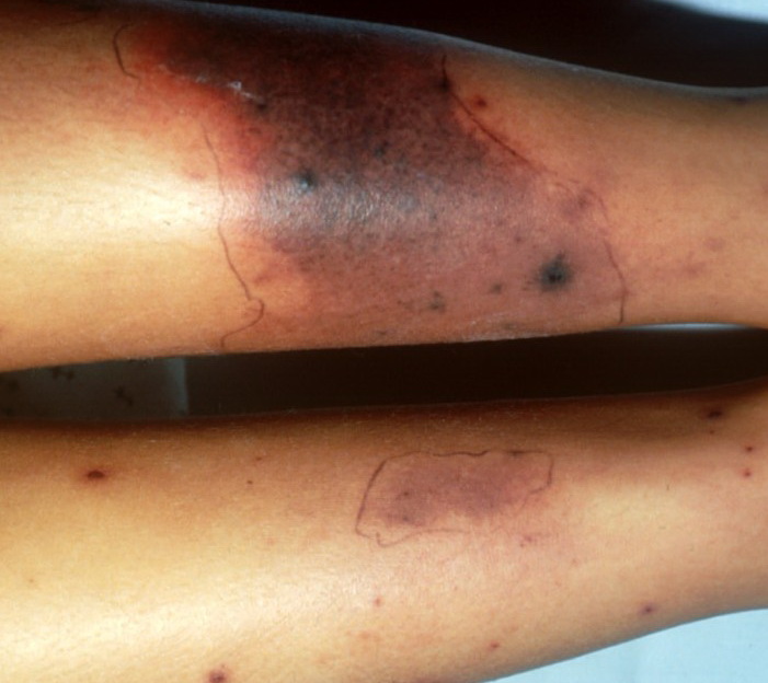 Purpura Fulminans Clinical Presentation: History