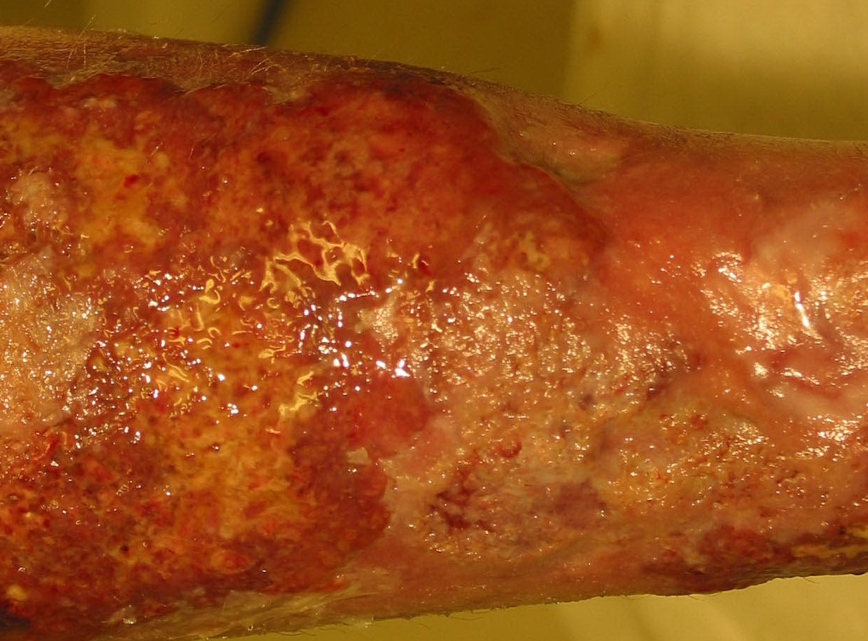 Pyoderma Gangrenosum Photo - Skin Disease Pictures