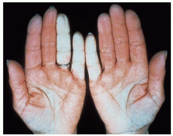 Raynaud's phenomenon - NHS Choices