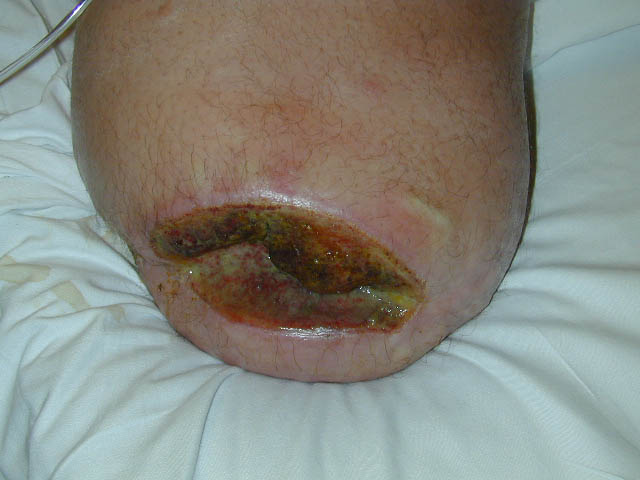 recurrent cellulitis