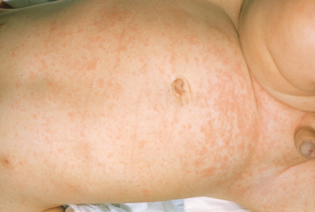 Roseola: MedlinePlus Medical Encyclopedia Image