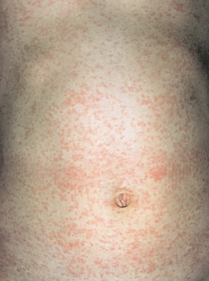 Rubella - Symptoms - NHS Choices