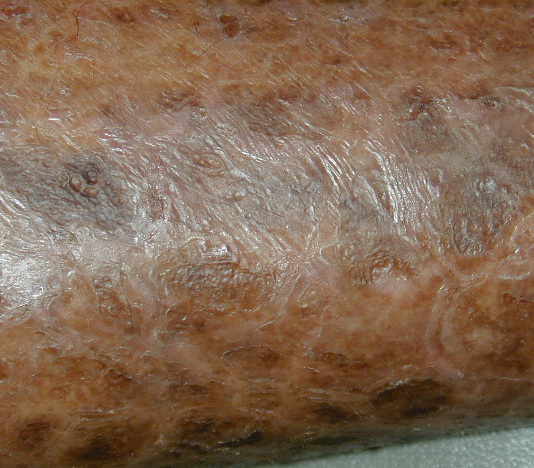 sarcoidosis skin