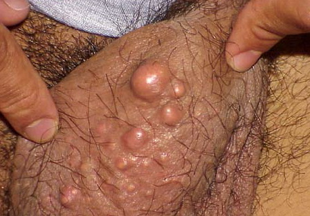 cyst on scrotum