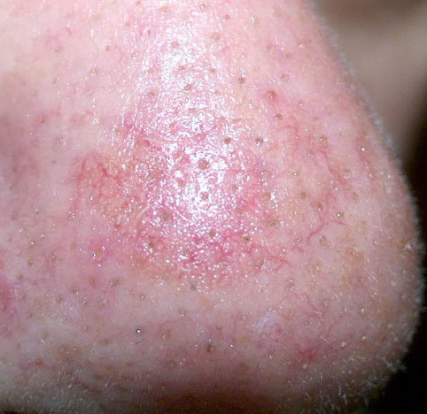 Keratosis actinica - Wikipedia