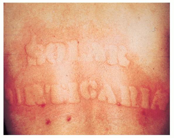 SOLAR URTICARIA - British Association of Dermatologists