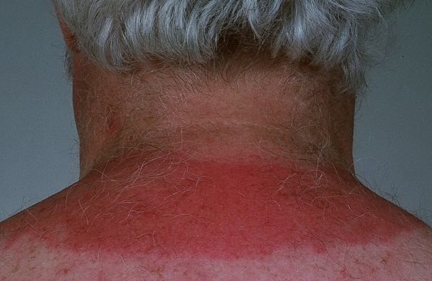 Solar Urticaria: Background, Epidemiology, Patient Education