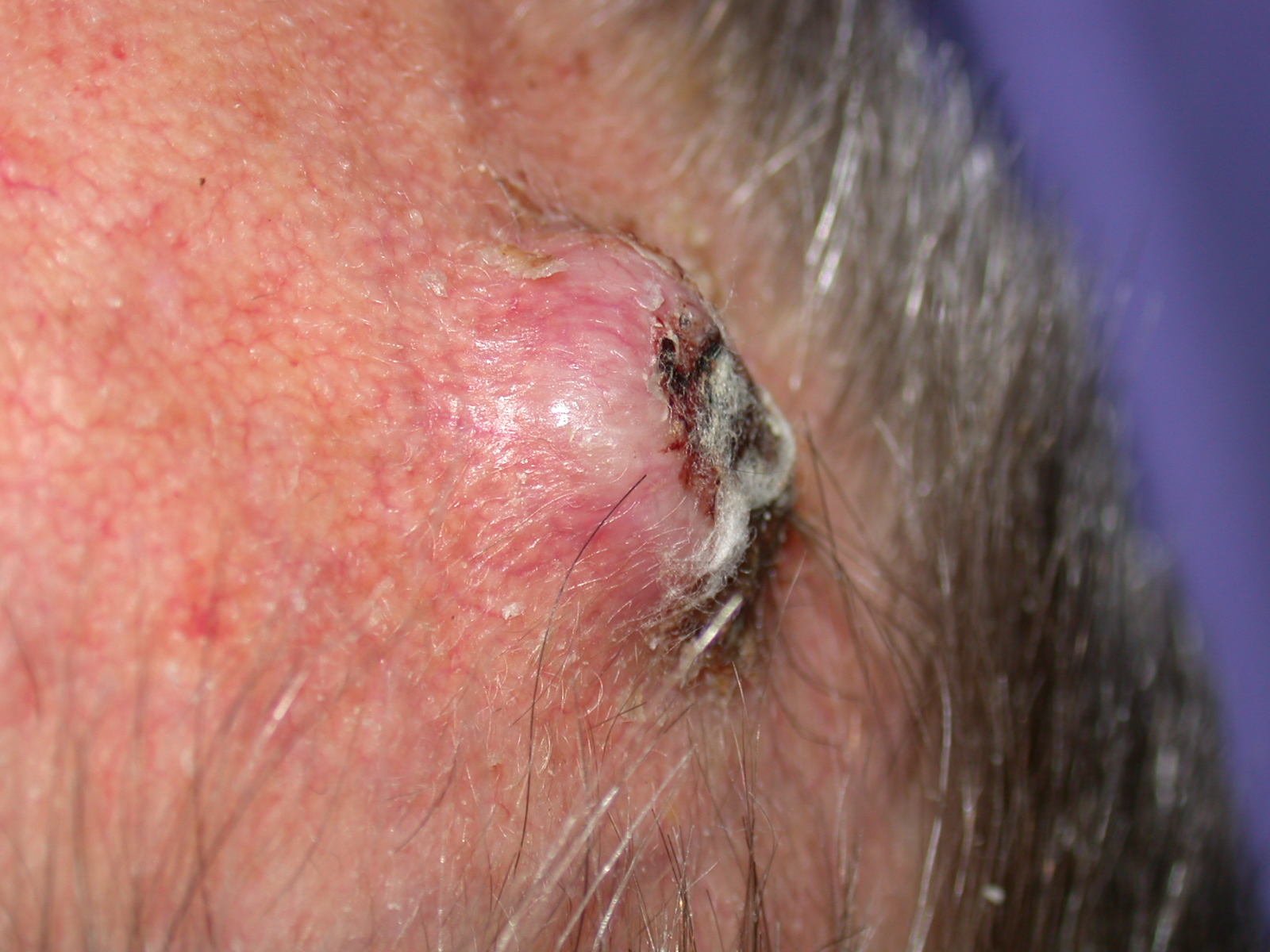 Pictures of Squamous Cell Carcinoma - Healthline
