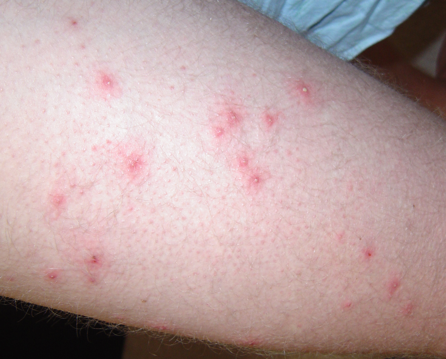 Folliculitis - Pictures, Symptoms, Treatment and Prevention